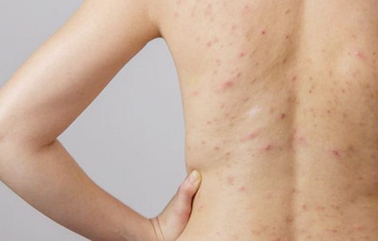 Chữa viêm lỗ chân lông hiệu quả bằng loại quả quen thuộc